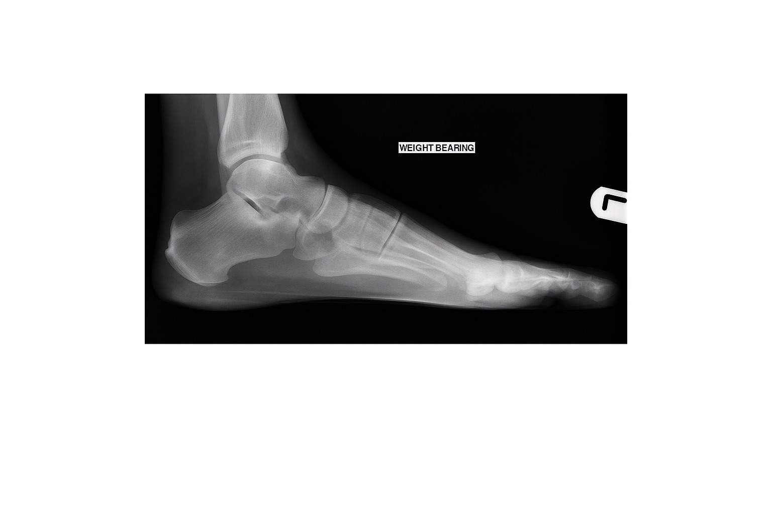 Xray of Foot
