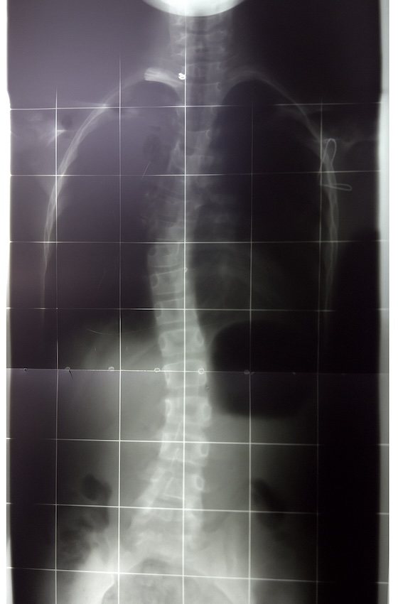 Spine Xray with scoliosis